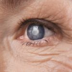 Cataracta: care sunt simptomele acestei afecțiuni și cum poate fi tratată