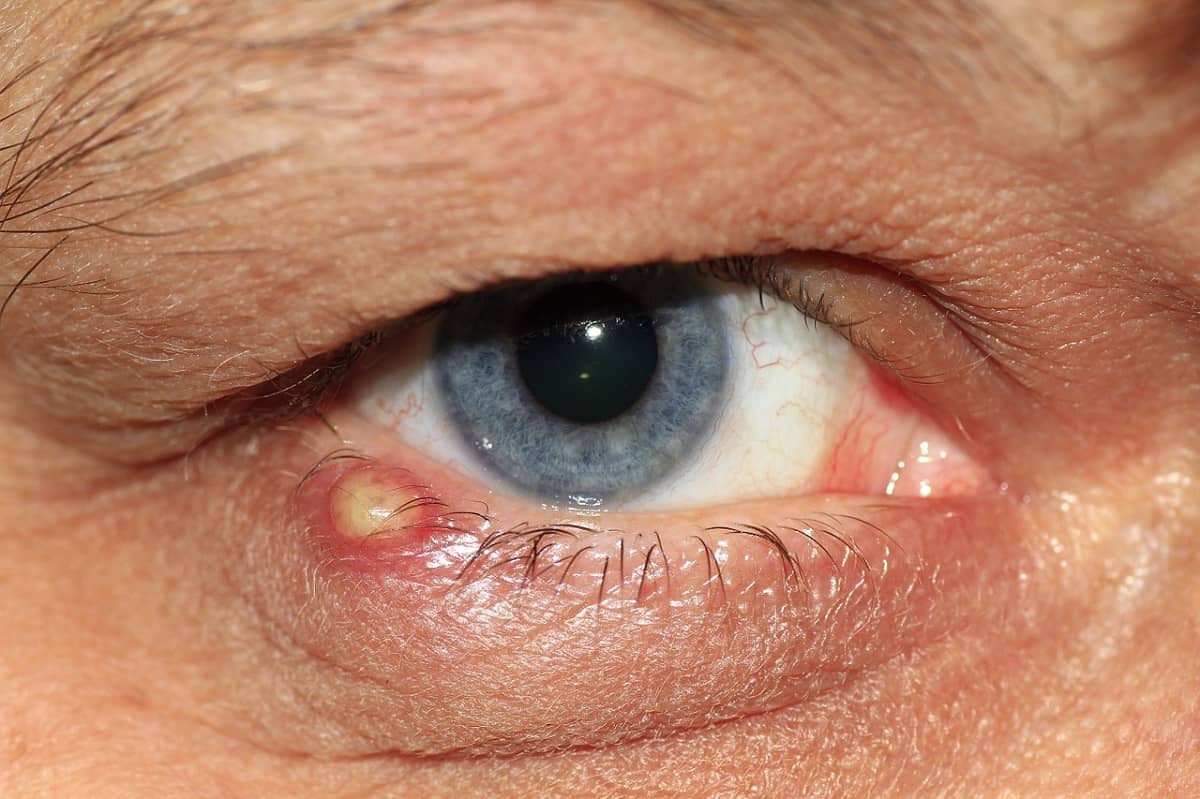 oftalmologia coace ochii ce să facă miopie minus 14