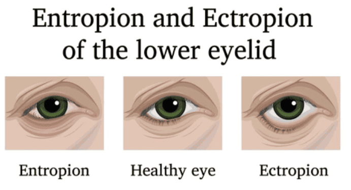 Ectropion la ochi - tipuri de ectropion - Imagini cu ectropion