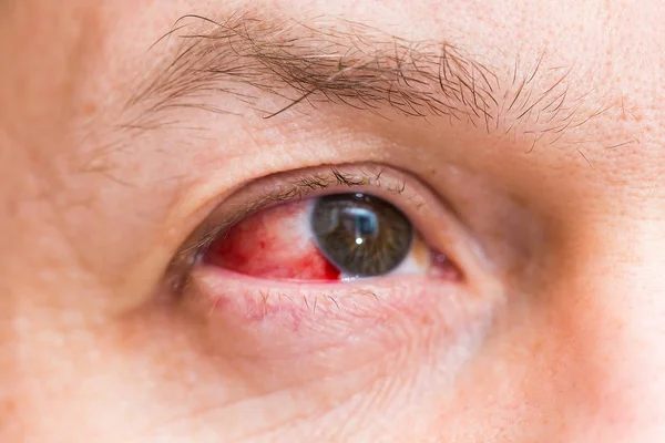 Traumatismul ochilor - care sunt cele mai întâlnite cauze şi simptome - Traumatism al ochiului, sângerare