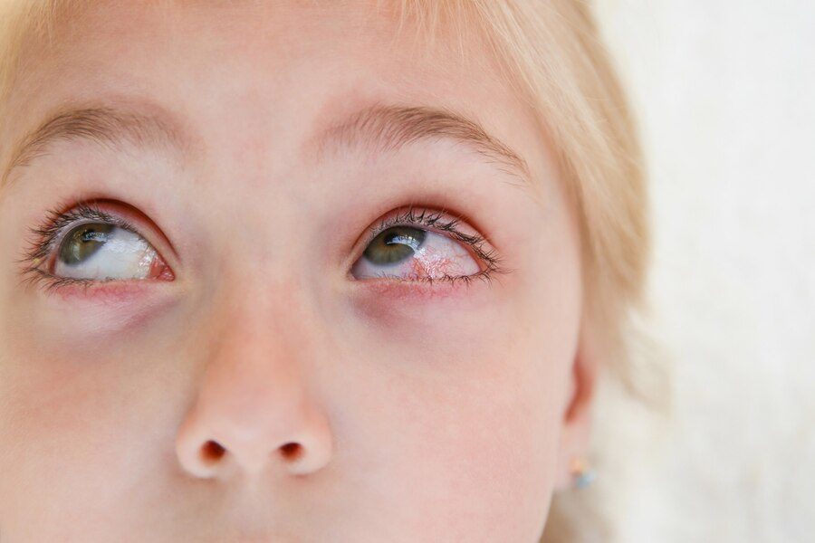 Vinisoare rosii pe albul ochilor la copii si bebelusi - care sunt factorii de risc si cum se pot trata venele rosii pe albul ochilor_Vinisoare rosii pe albul ochilor la copii