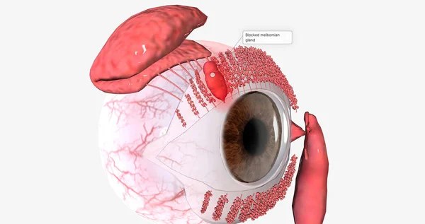 Chalazion - informații generale - Reprezentare 3D formare chalazion