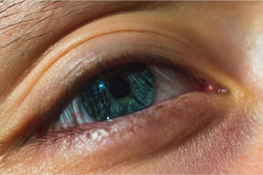 Paralizia Bell - ochi albastru, gene