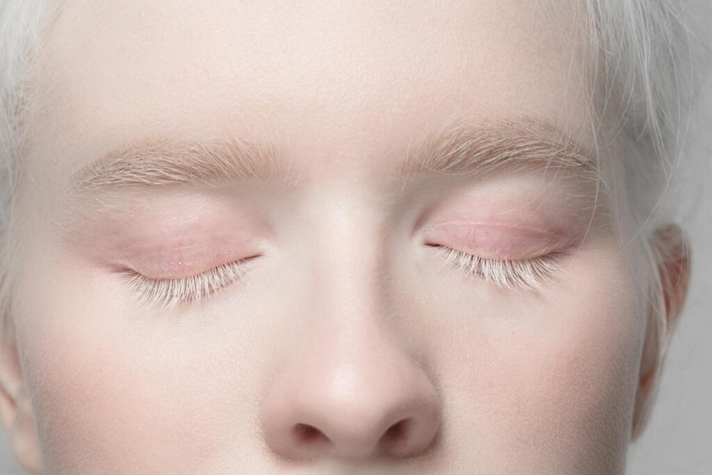 Albinism simptome_femeie, nas, ochi