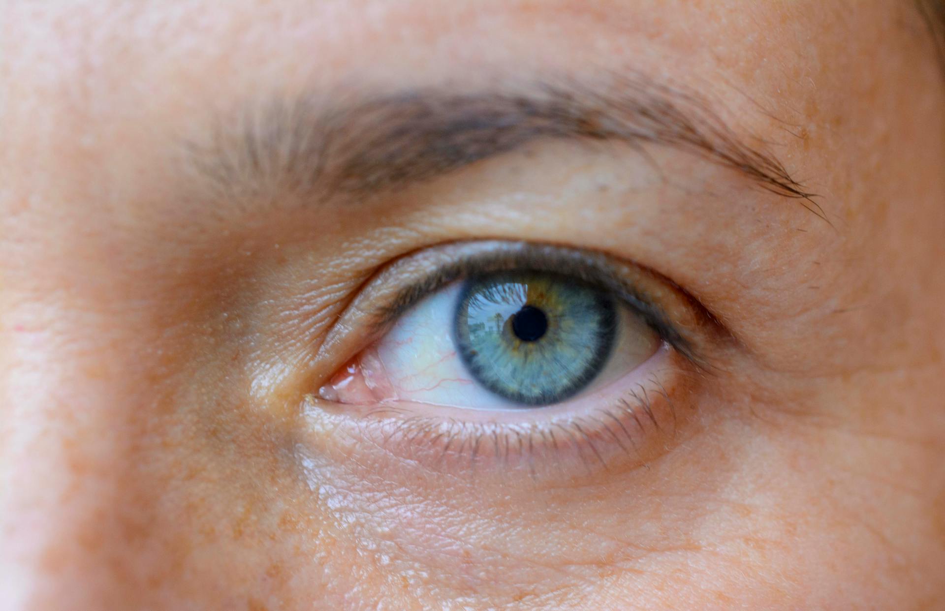 nistagmus, operatie nistagmus, ochi albastru