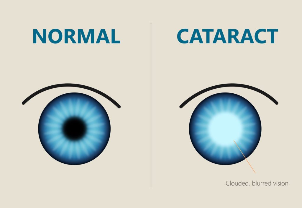 cataracta, afecțiune, oftalmologie cataracta simptome