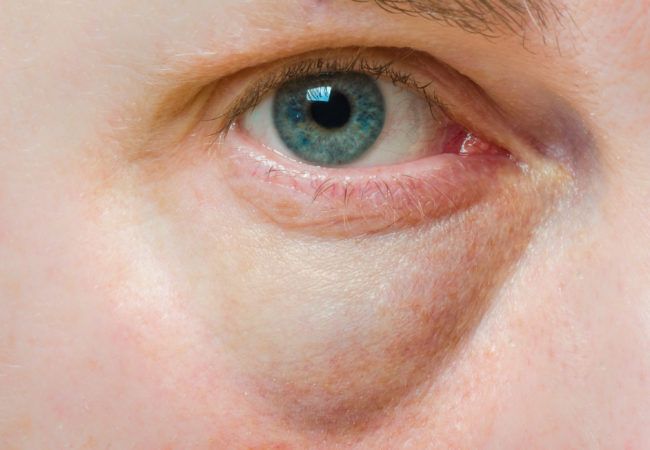edem infraorbital